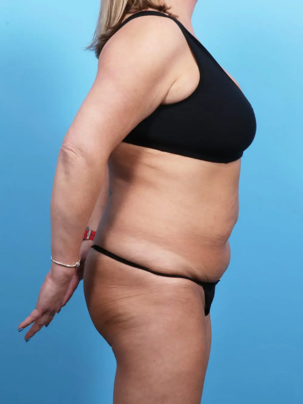 Tummy Tuck Patient Photo - Case 18899 - before view-2