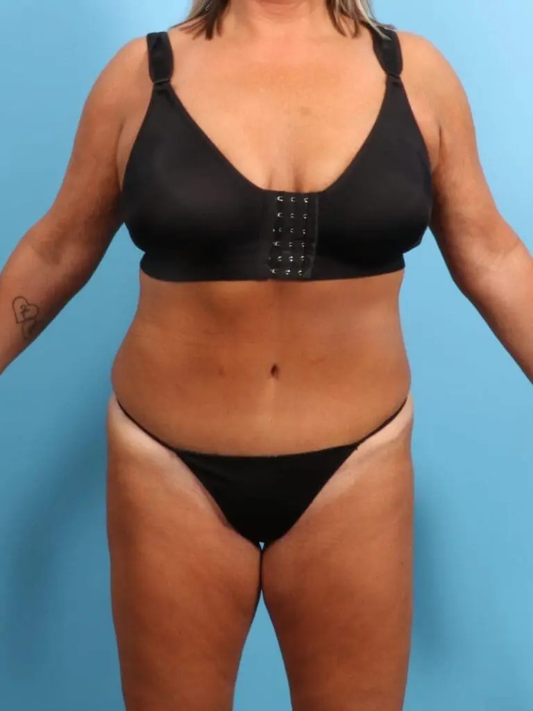 Tummy Tuck - Case 18899 - After