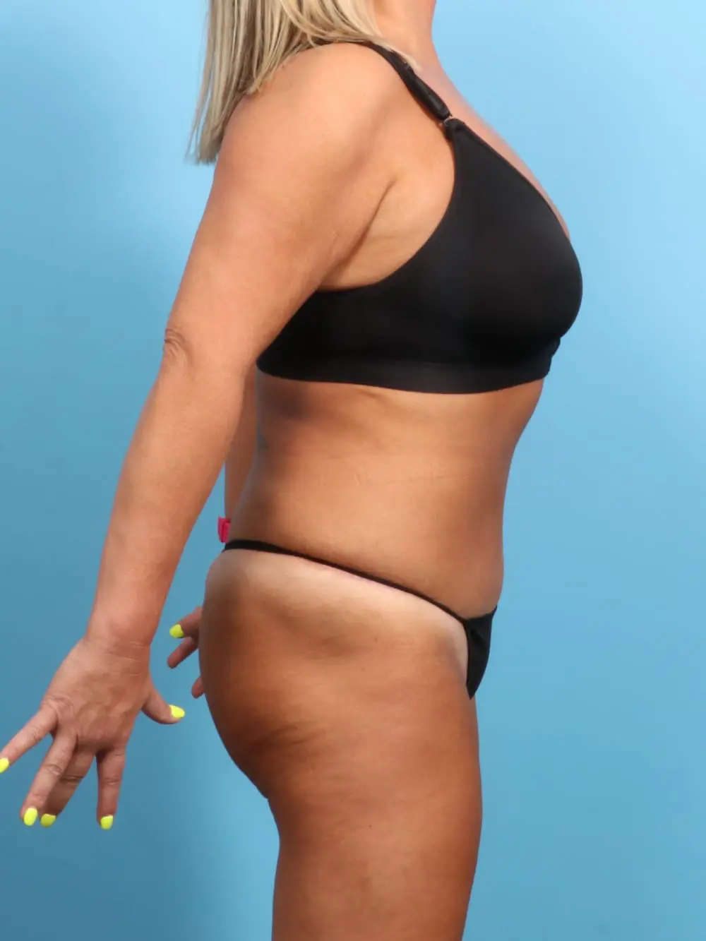 Tummy Tuck Patient Photo - Case 18899 - after view-2