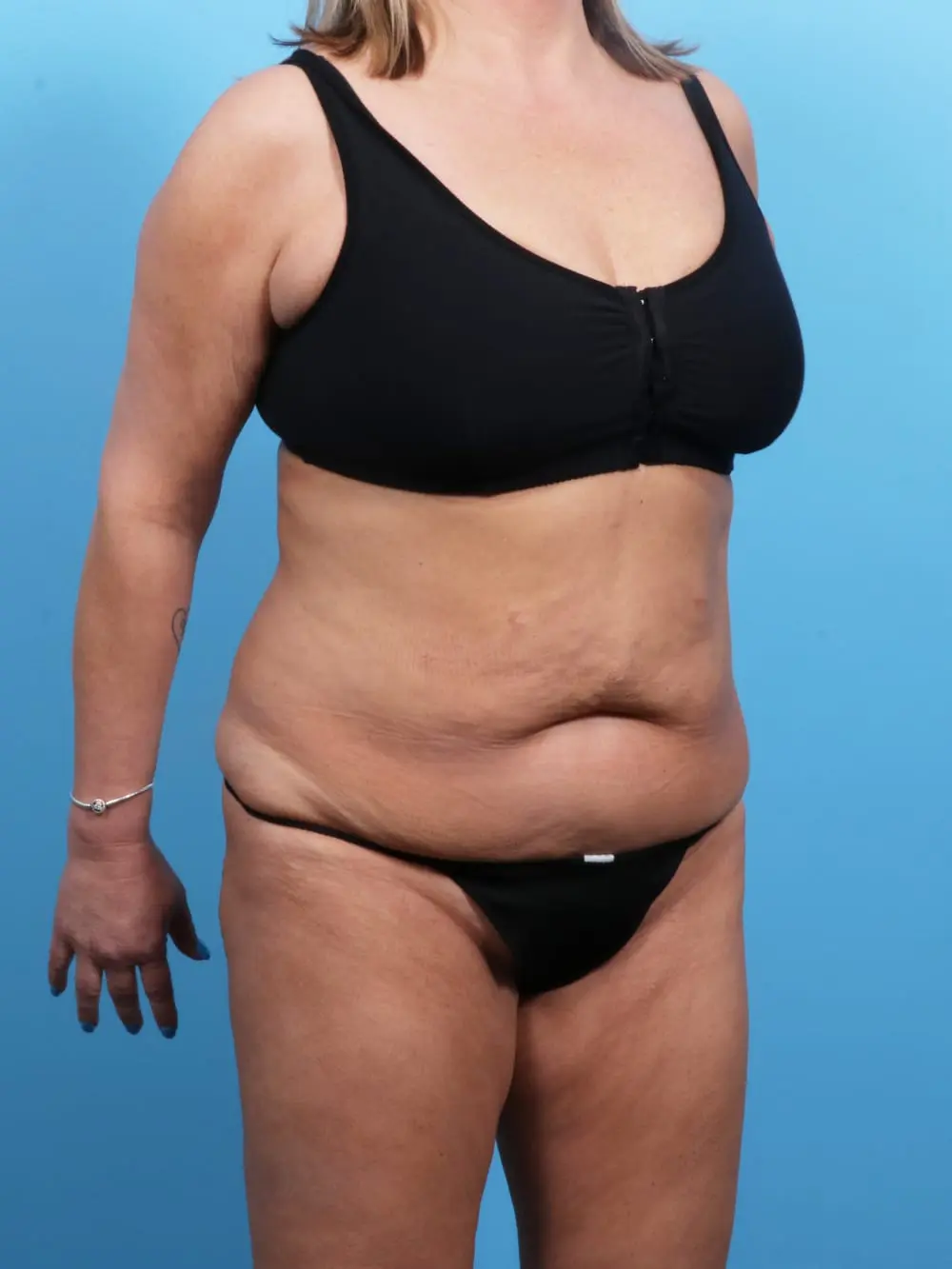 Tummy Tuck Patient Photo - Case 18899 - before view-1