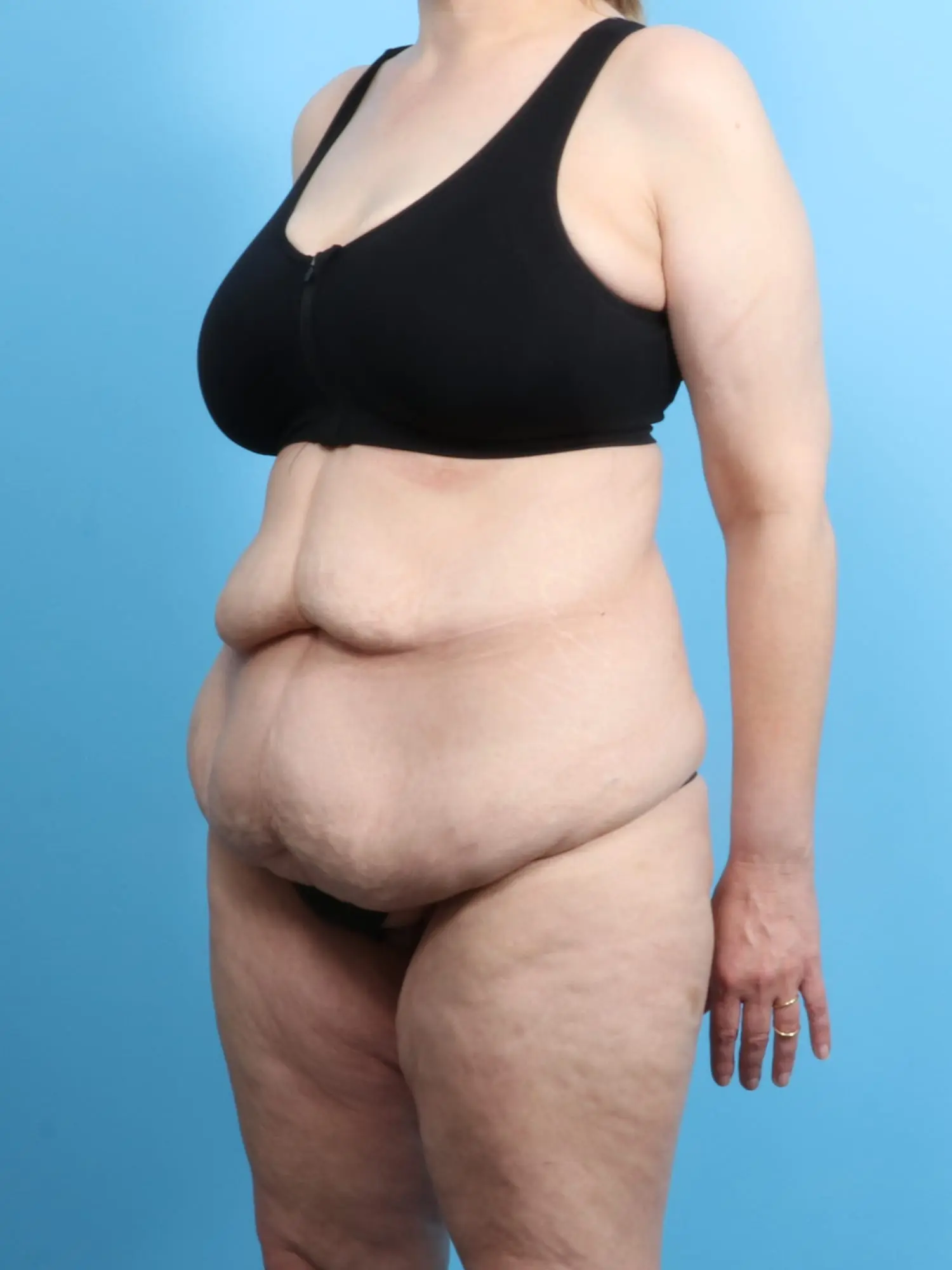 After Weight Loss Patient Photo - Case 18956 - before view-1