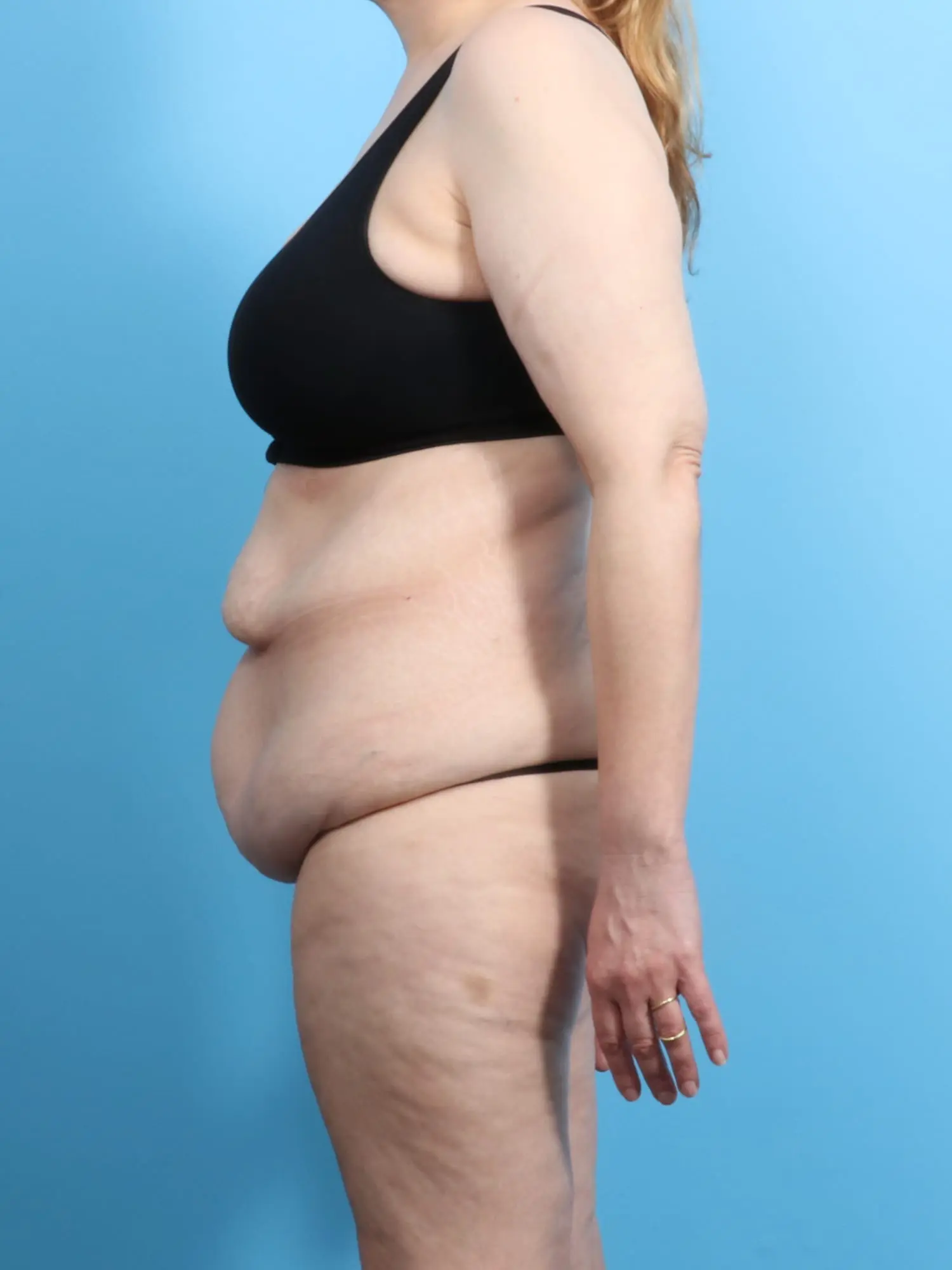 After Weight Loss Patient Photo - Case 18956 - before view-2