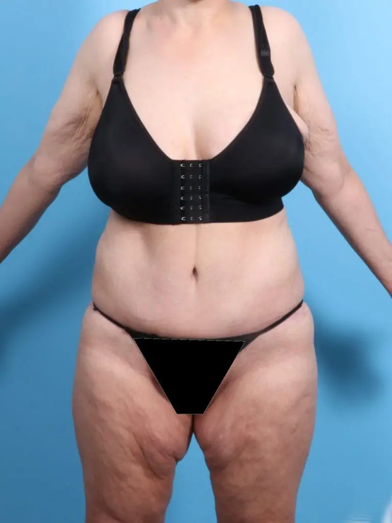 After Weight Loss - Case 18956 - After