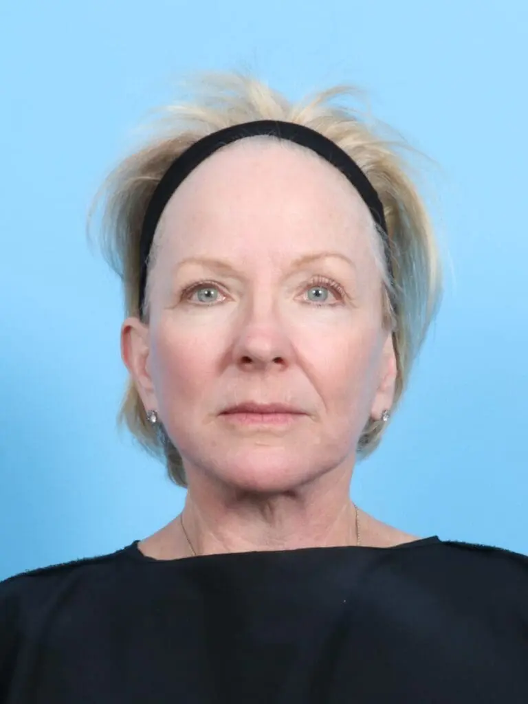 Facelift / Neck Lift - Case 19048 - After