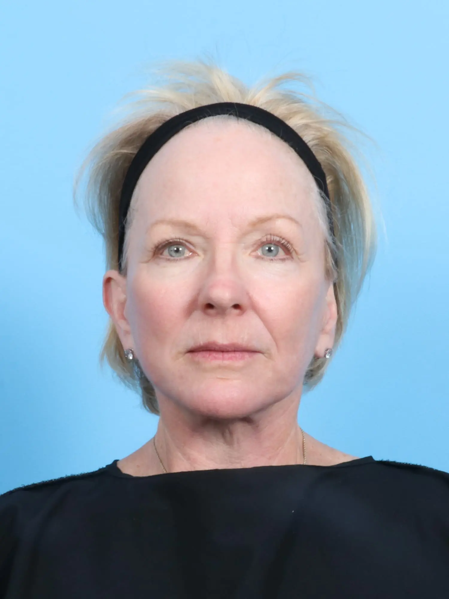 After CO2 Laser Resurfacing