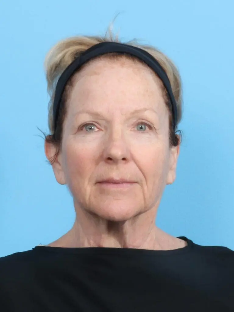 Facelift / Neck Lift - Case 19048 - Before