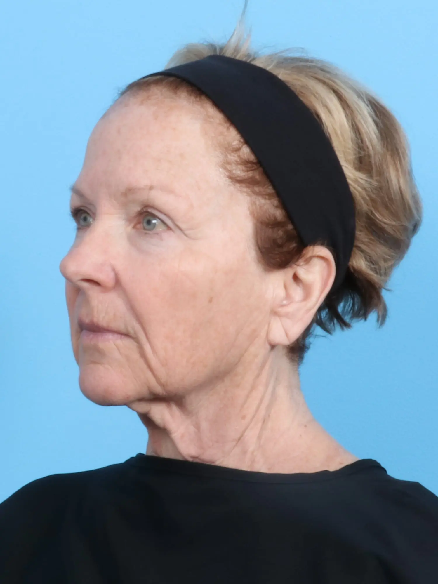 Facelift / Neck Lift Patient Photo - Case 19048 - before view-1