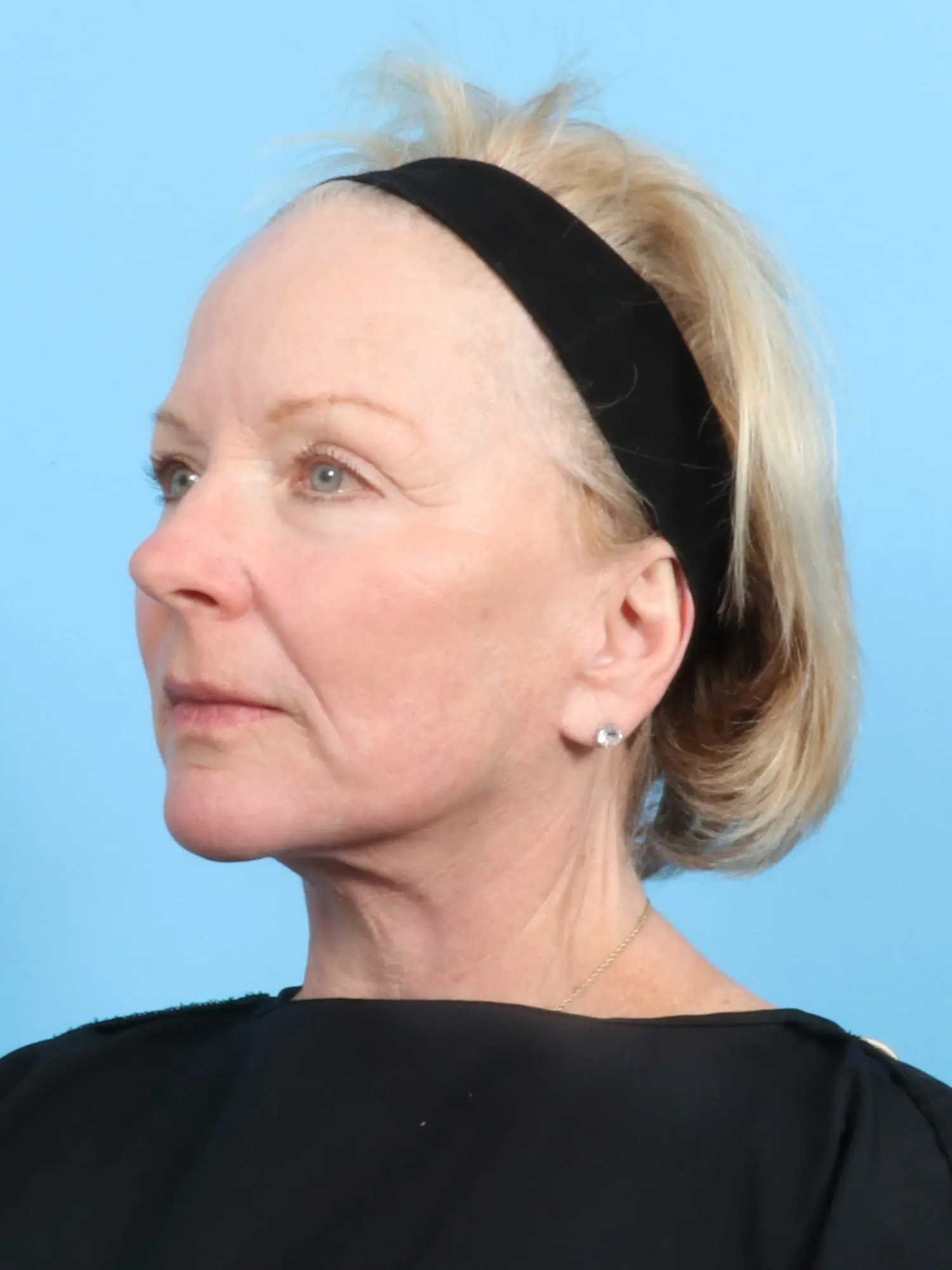 Facelift / Neck Lift Patient Photo - Case 19048 - after view-1