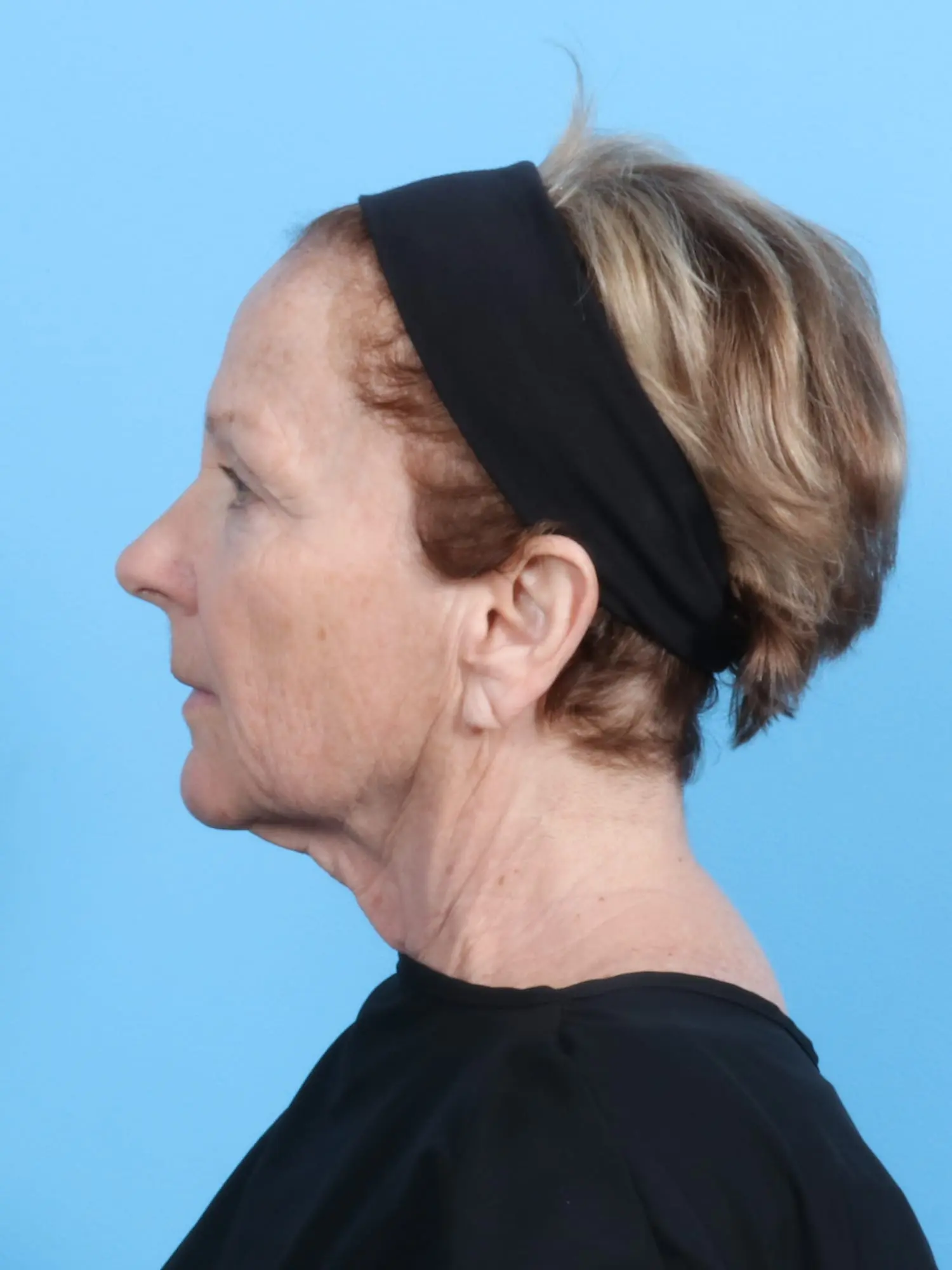 Facelift / Neck Lift Patient Photo - Case 19048 - before view-2