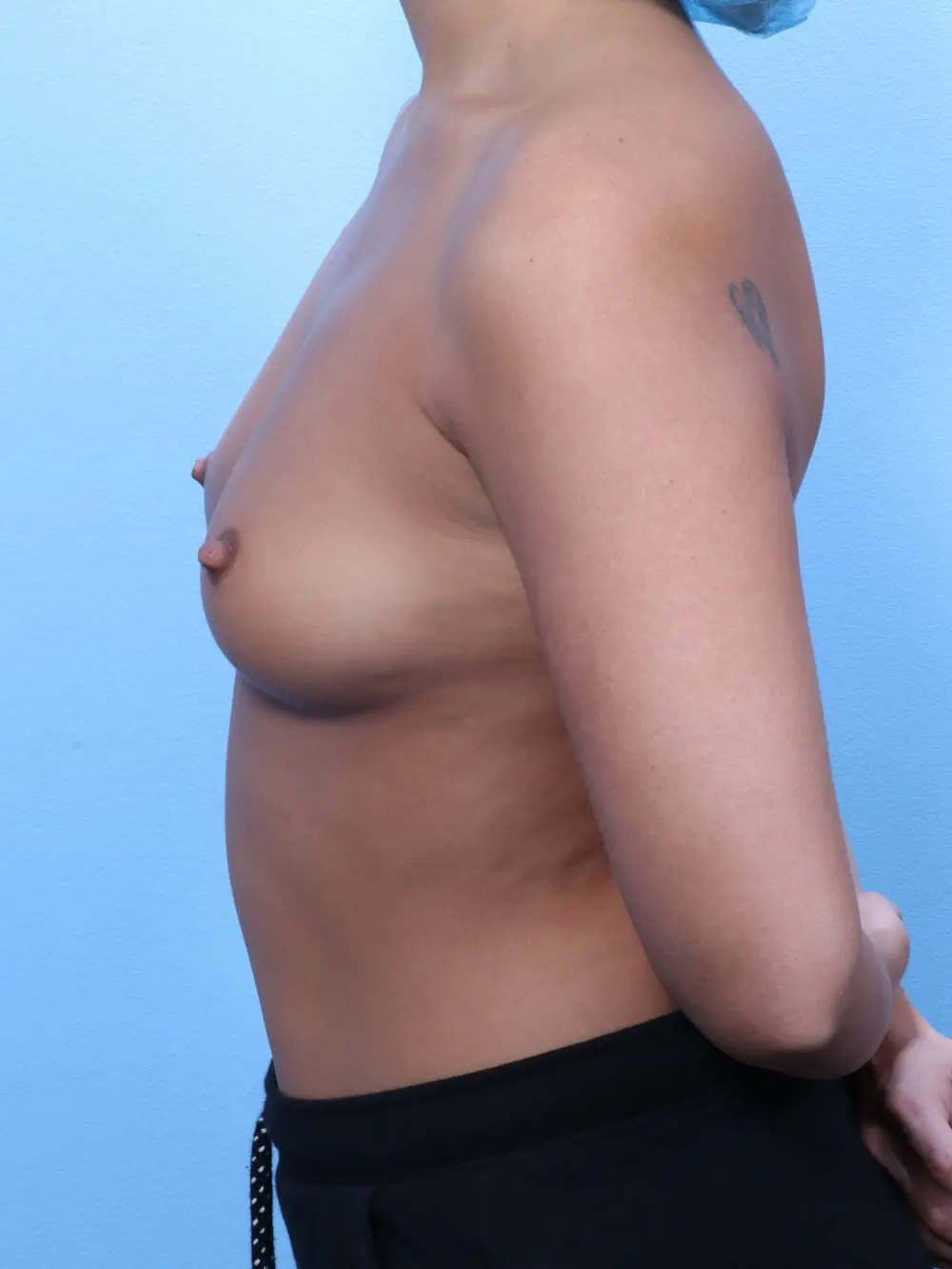 Breast Augmentation Patient Photo - Case 19153 - before view-2