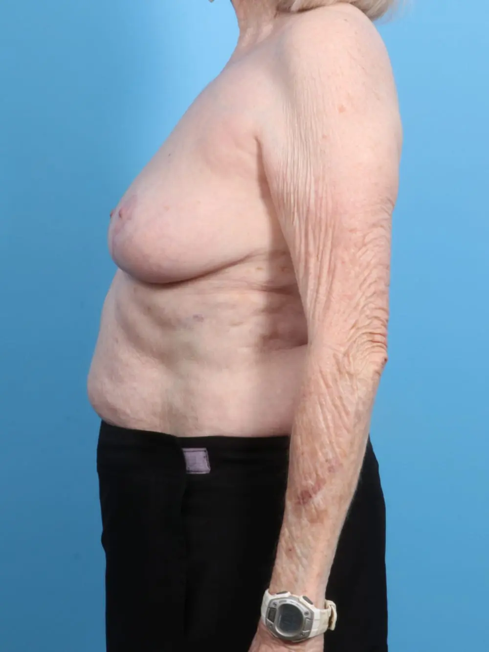 Breast Lift/Reduction w/o Implants Patient Photo - Case 19162 - after view-2