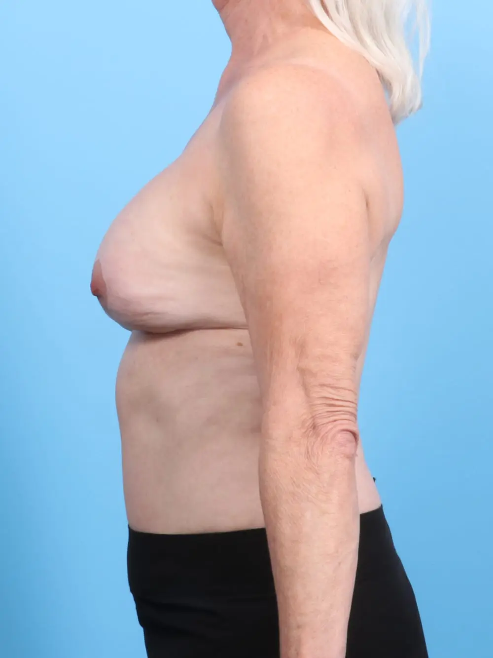 Breast Implant Revision Patient Photo - Case 19194 - before view-2