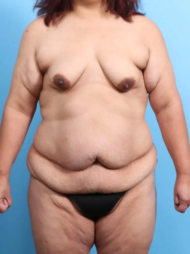 After Weight Loss - Case 19218 - Before