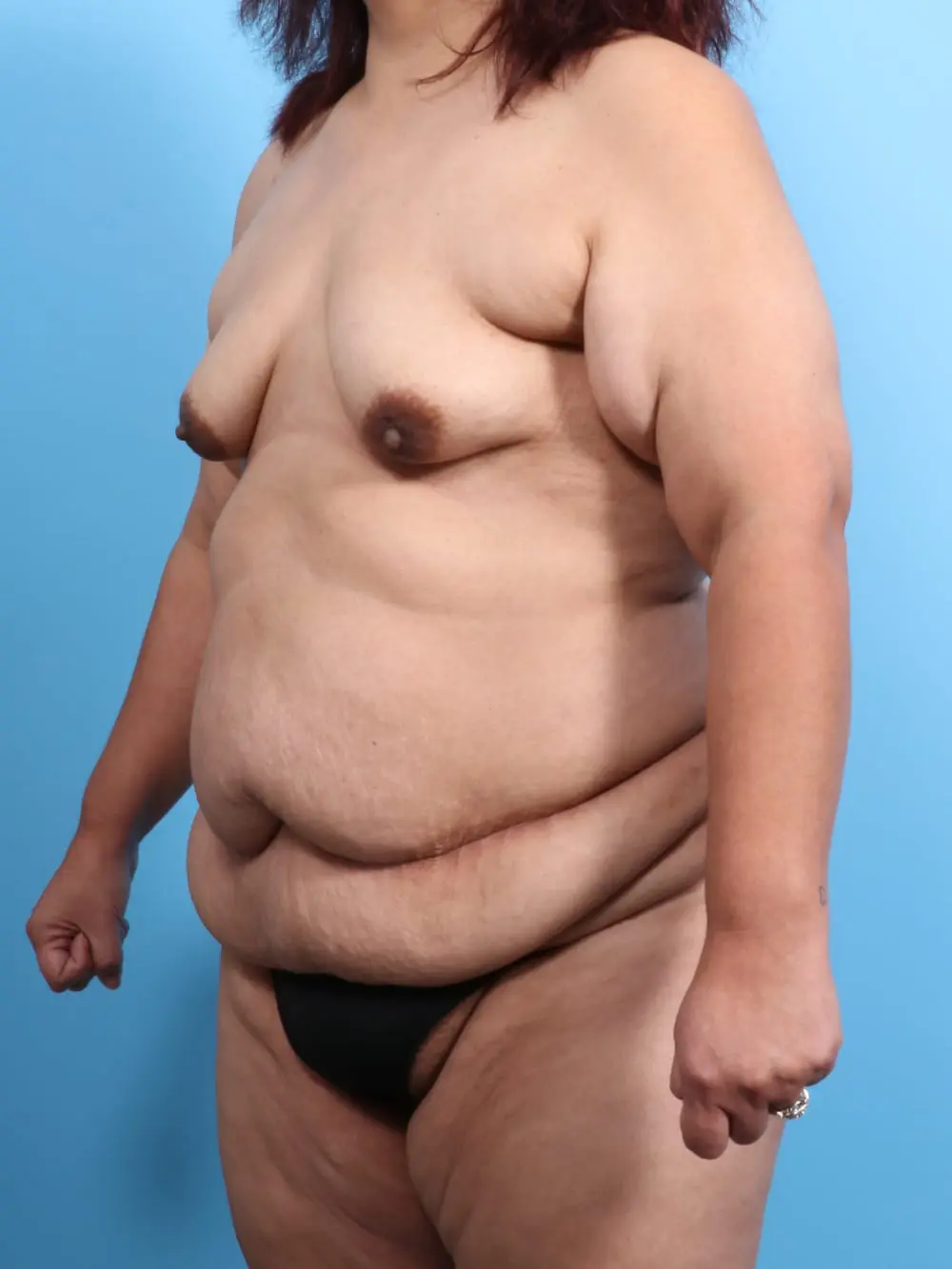 After Weight Loss Patient Photo - Case 19218 - before view-1