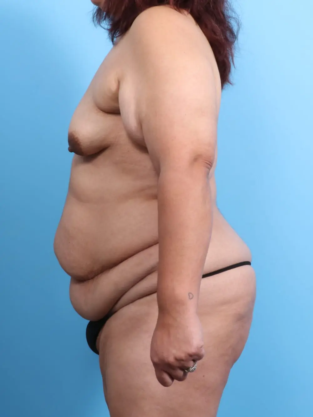 After Weight Loss Patient Photo - Case 19218 - before view-2