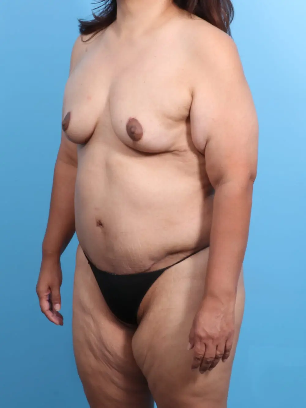 After Weight Loss Patient Photo - Case 19218 - after view-1