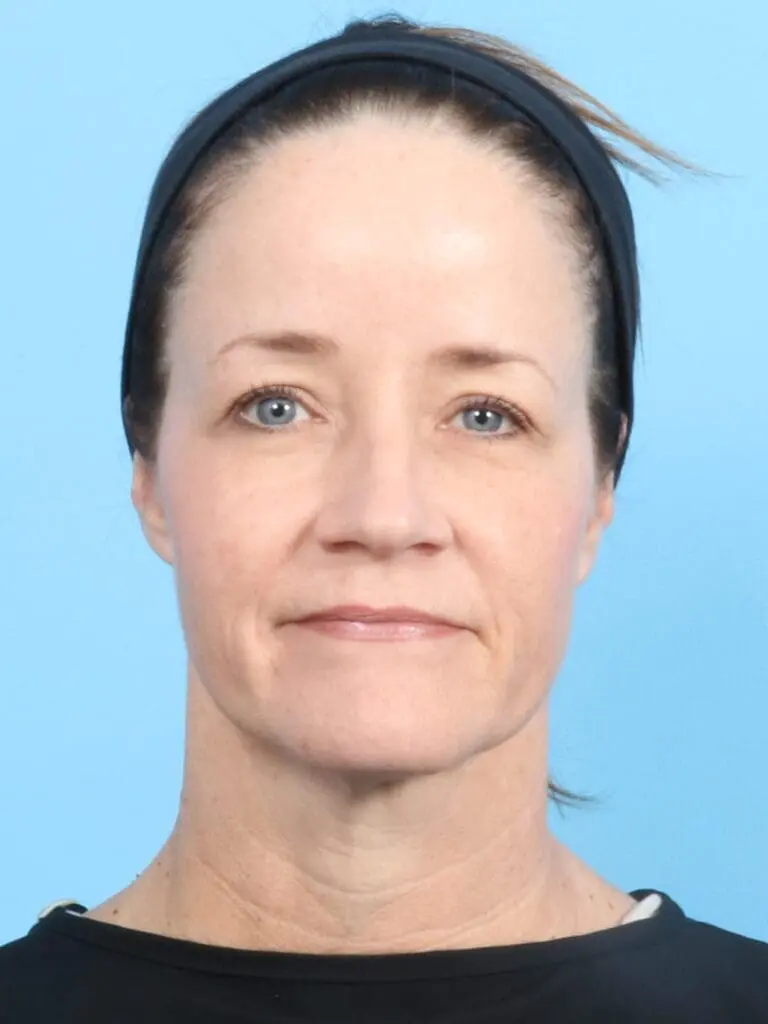 Eyelid Surgery - Case 19226 - Before