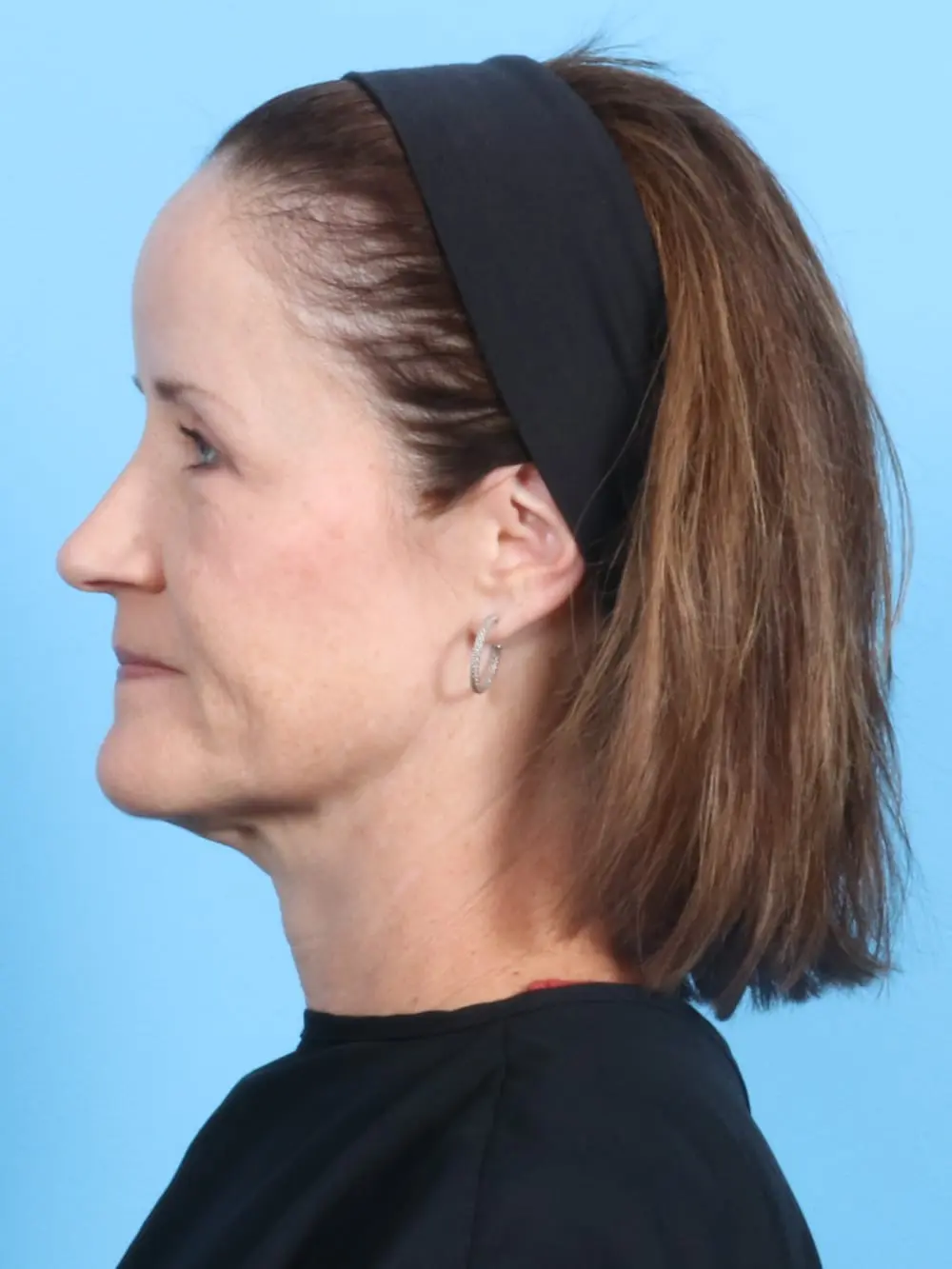 Eyelid Surgery Patient Photo - Case 19226 - after view-2