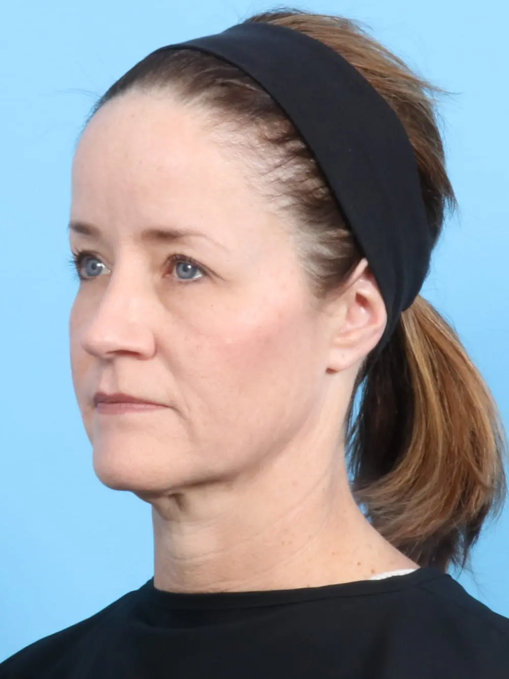 Eyelid Surgery Patient Photo - Case 19226 - before view-1