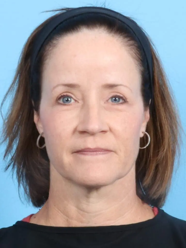 Eyelid Surgery - Case 19226 - After