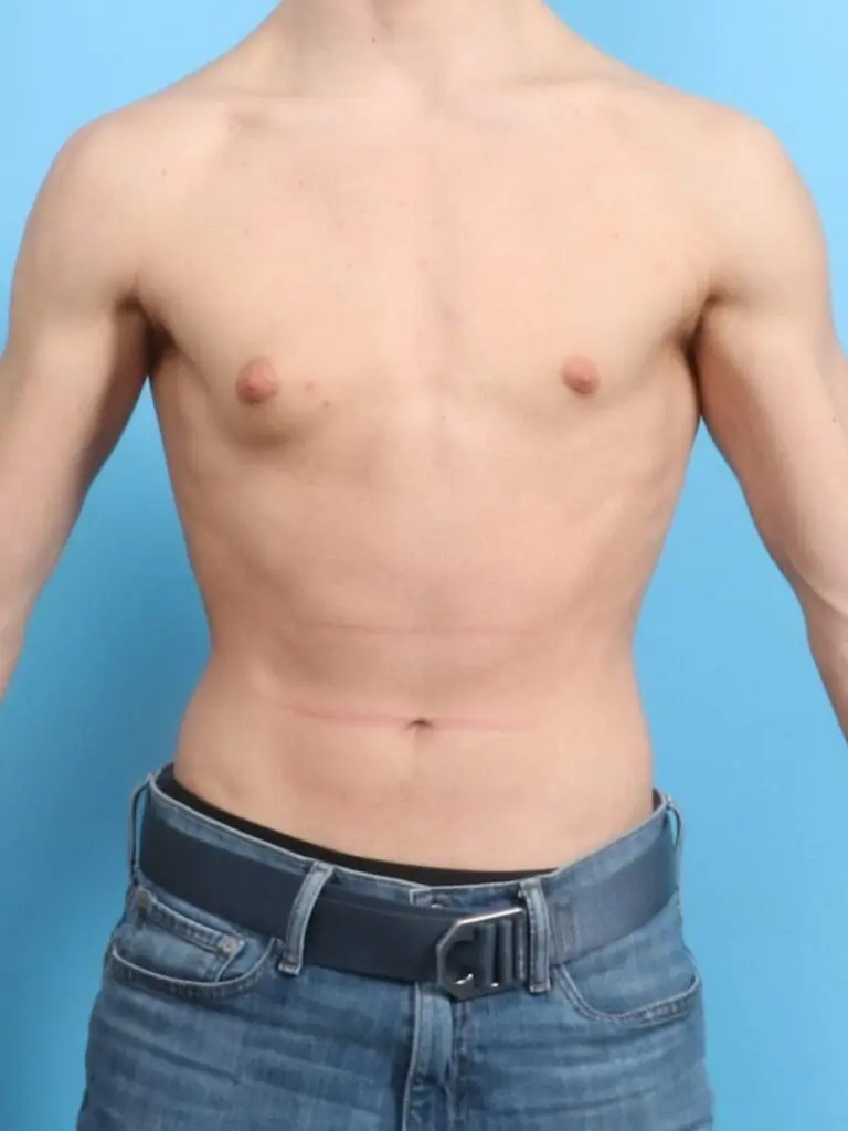 Gynecomastia - Case 19258 - Before