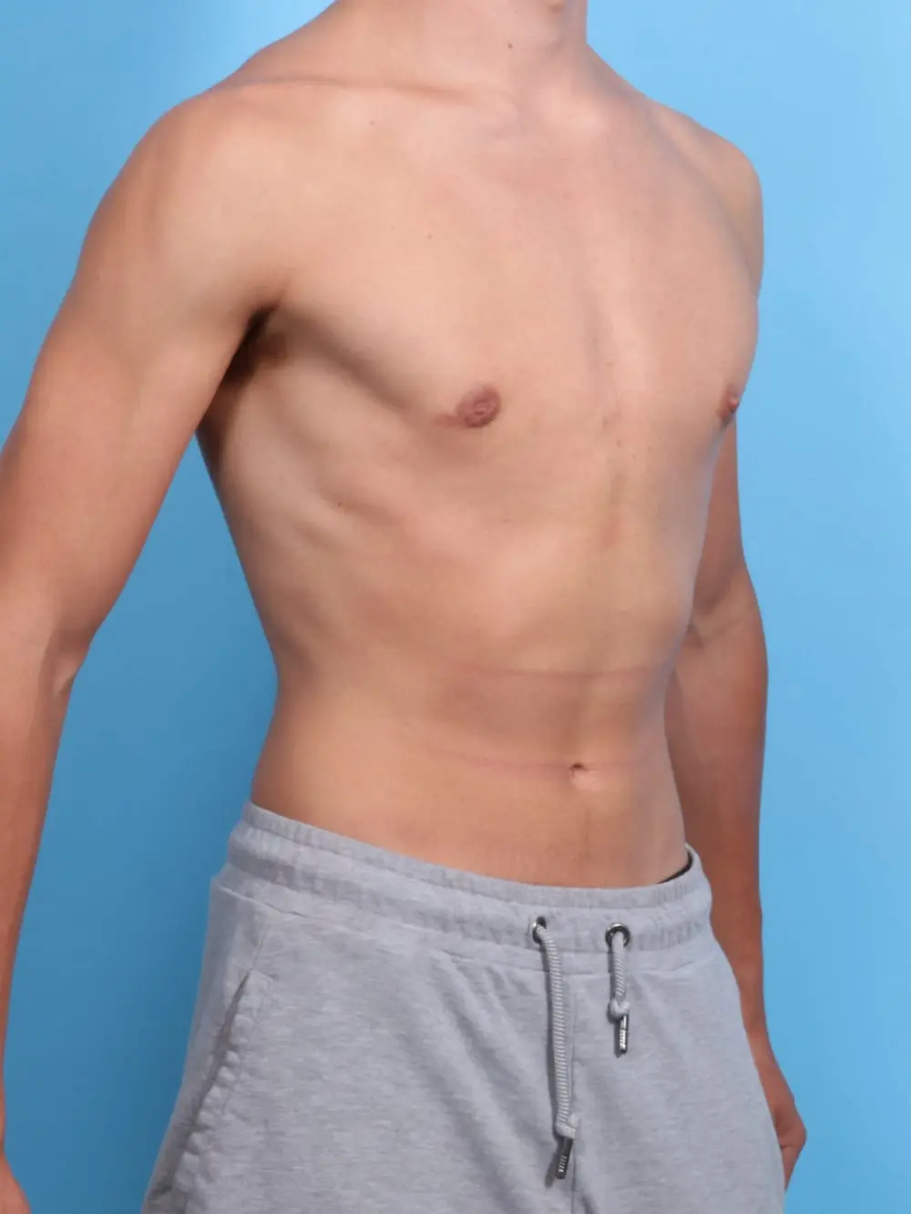 Gynecomastia Patient Photo - Case 19258 - after view-1