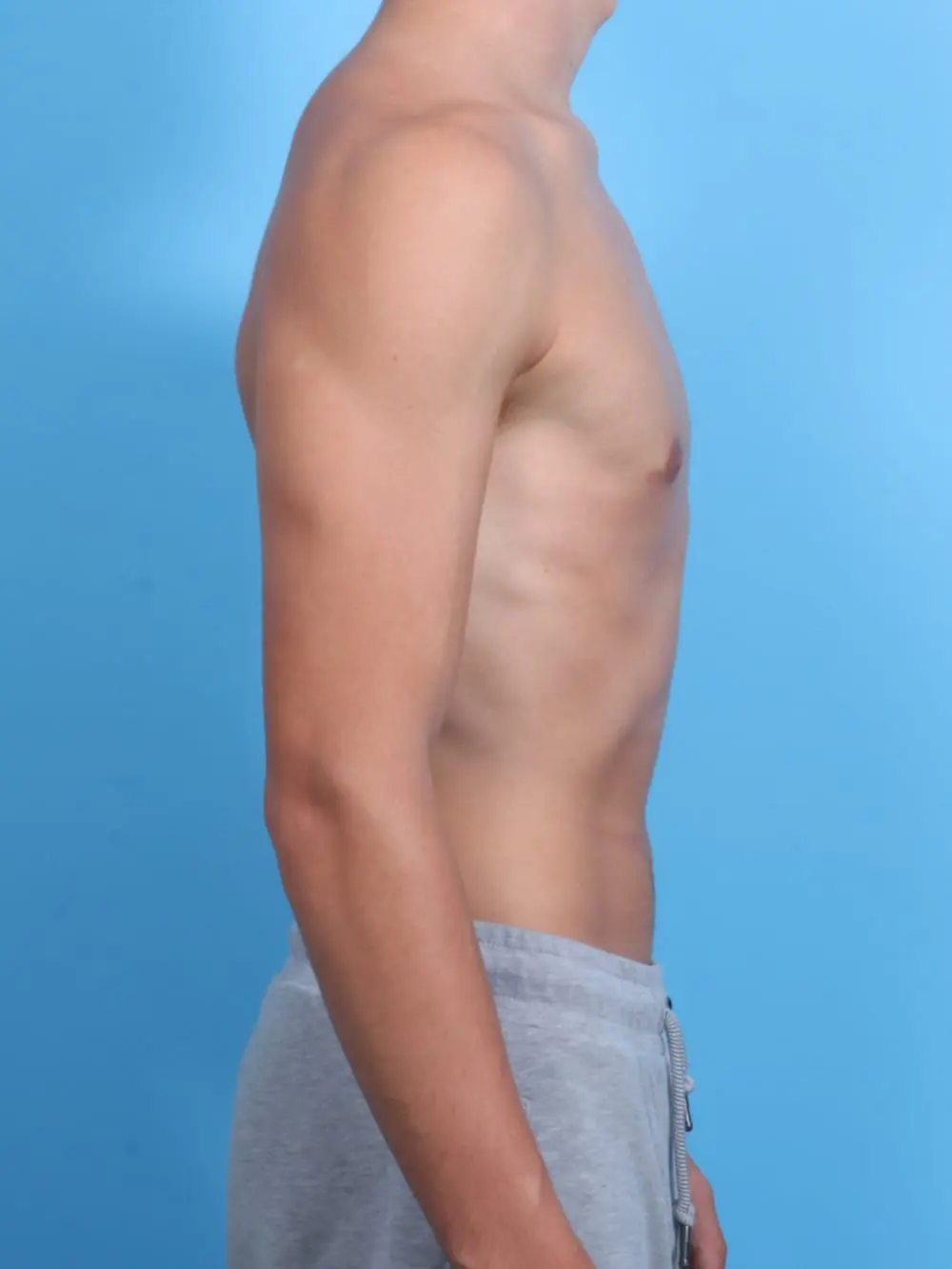 Gynecomastia Patient Photo - Case 19258 - after view-2
