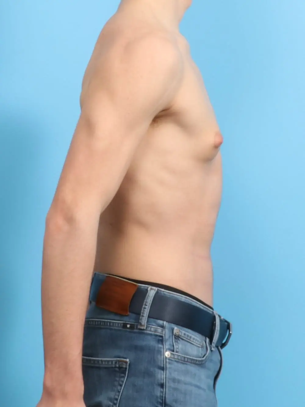 Gynecomastia Patient Photo - Case 19258 - before view-2