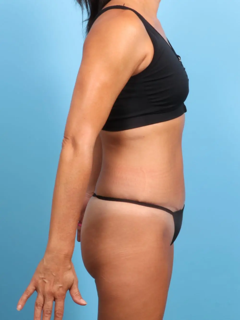 Tummy Tuck Patient Photo - Case 19377 - after view-2