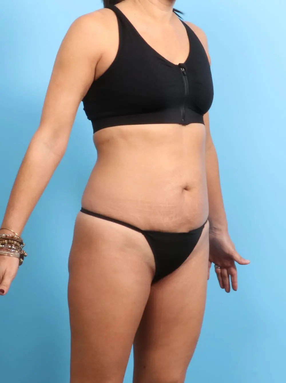 Tummy Tuck Patient Photo - Case 19377 - before view-1