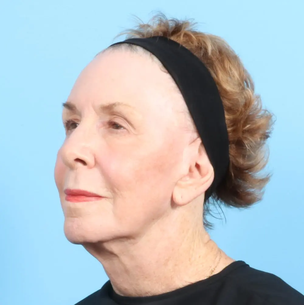 Fat Transfer Patient Photo - Case 19404 - after view-1