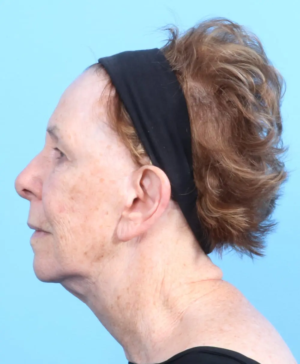 Fat Transfer Patient Photo - Case 19404 - before view-2