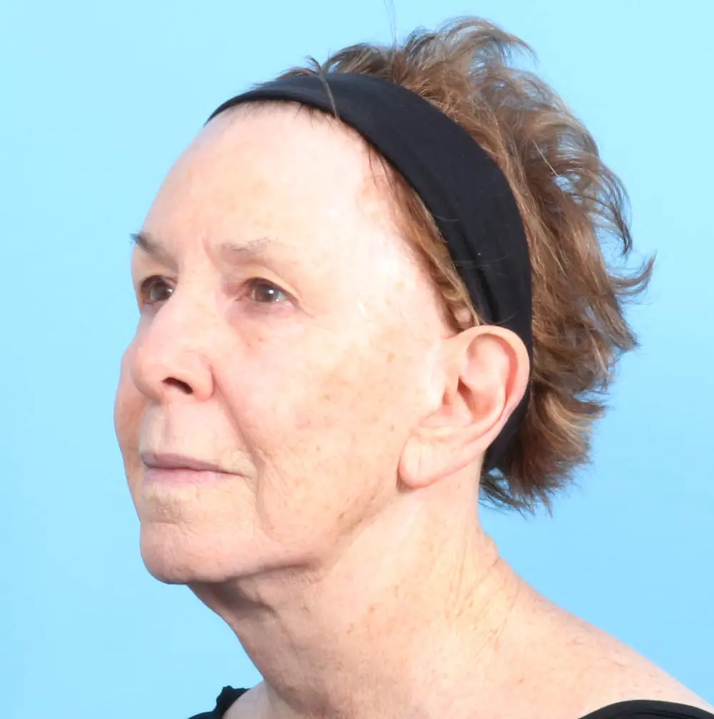 Fat Transfer Patient Photo - Case 19404 - before view-1