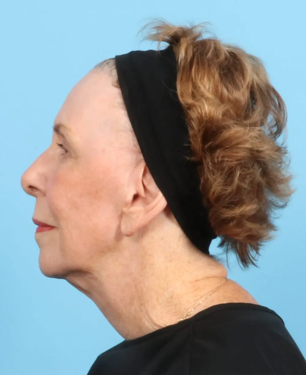 Fat Transfer Patient Photo - Case 19404 - after view-2