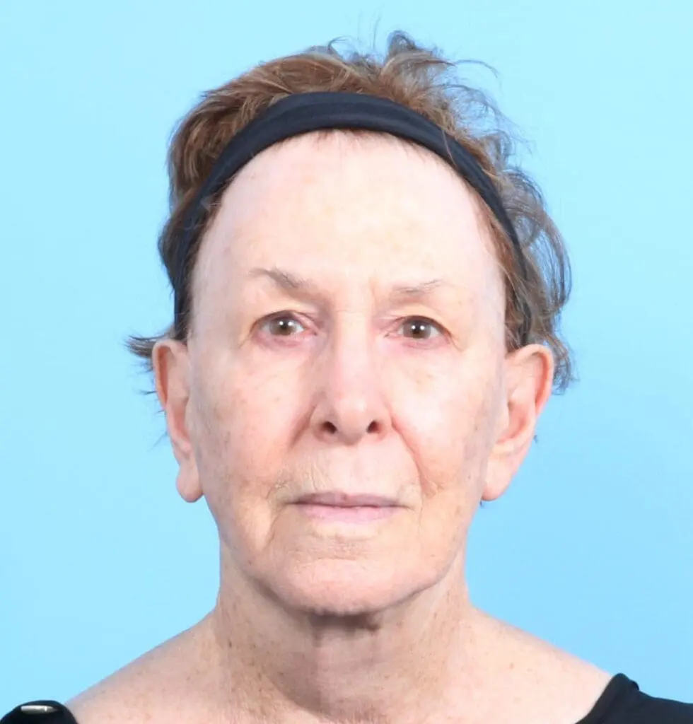 Fat Transfer - Case 19404 - Before