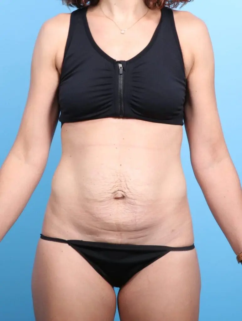 Tummy Tuck - Case 19445 - Before