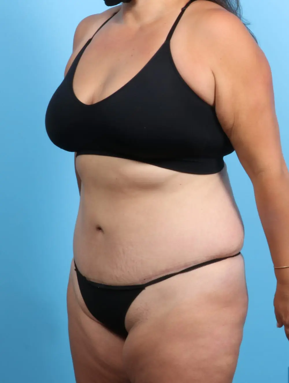 Tummy Tuck Patient Photo - Case 19457 - after view-1