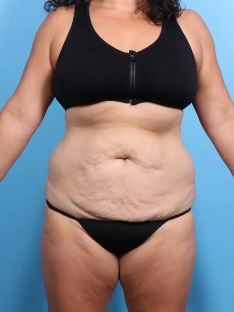 Tummy Tuck - Case 19457 - Before