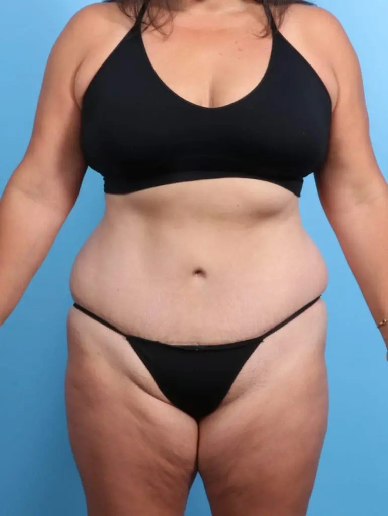 Tummy Tuck - Case 19457 - After