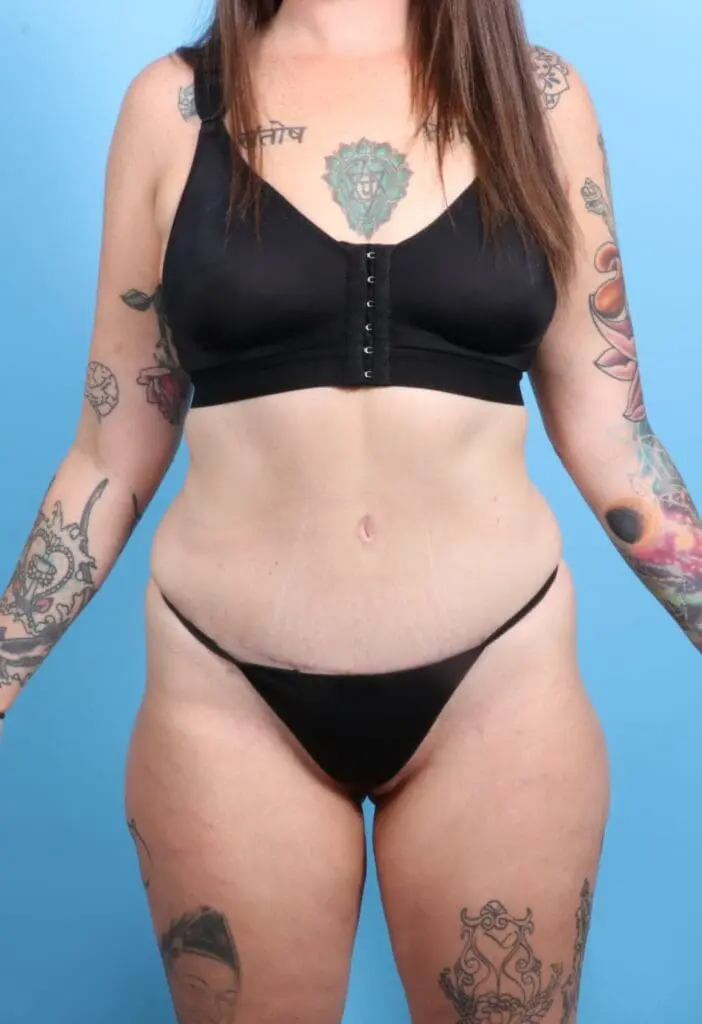 Tummy Tuck - Case 19473 - After