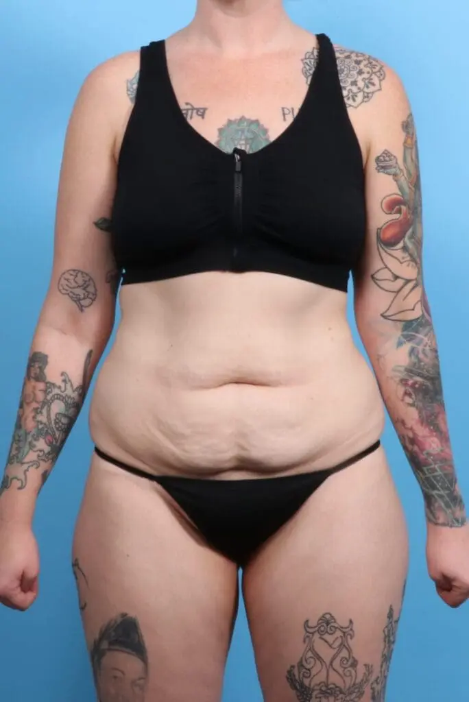 Tummy Tuck - Case 19473 - Before