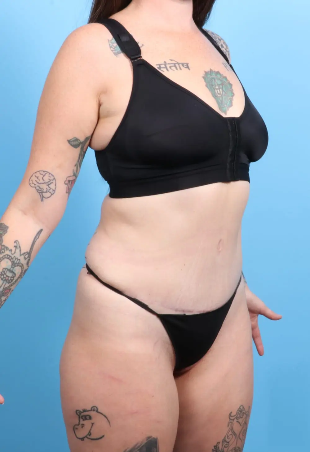 Tummy Tuck Patient Photo - Case 19473 - after view-1