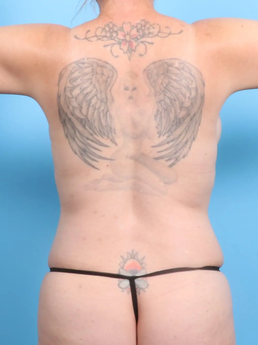 Breast Lift/Reduction with Implants Patient Photo - Case 19505 - after view-3