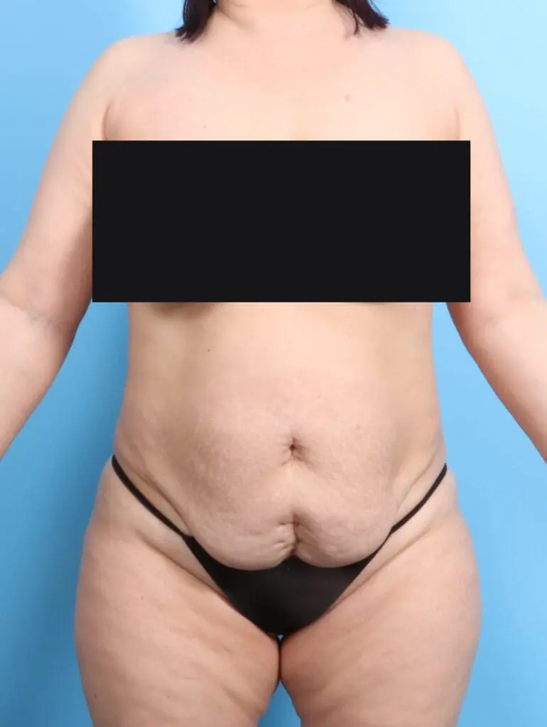 Tummy Tuck - Case 19789 - Before