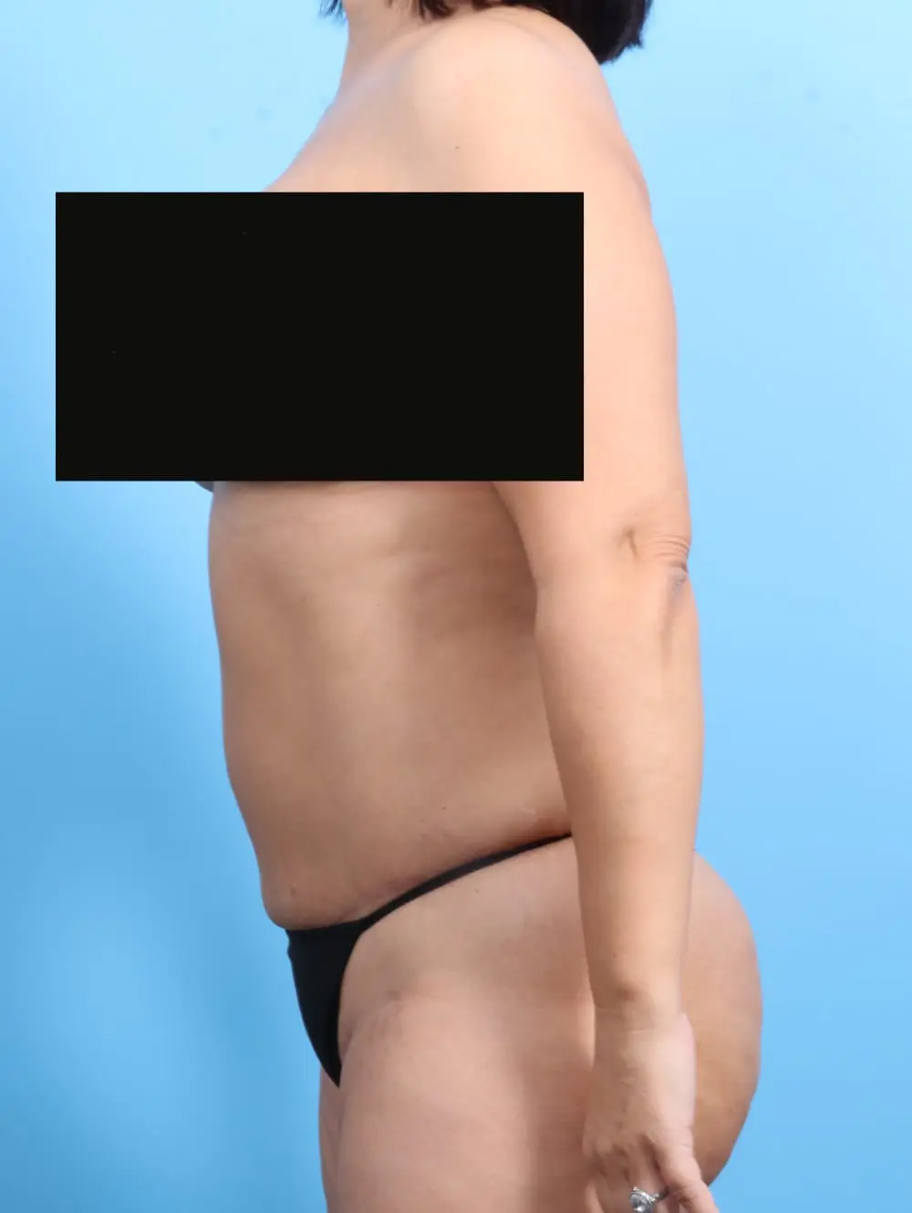 Tummy Tuck Patient Photo - Case 19789 - after view-2