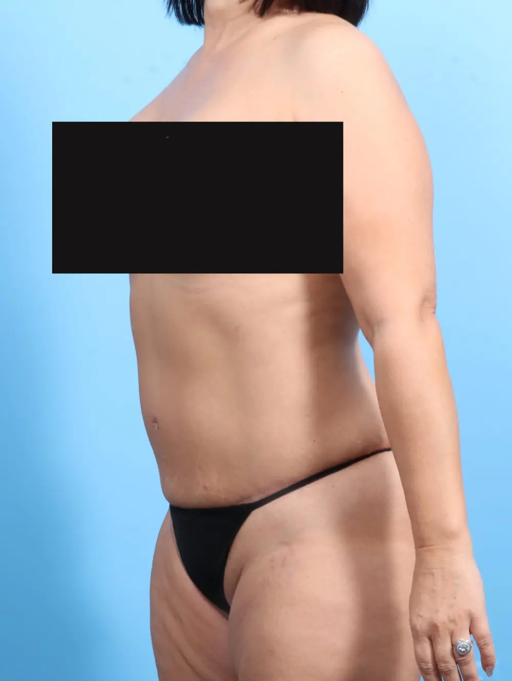 Tummy Tuck Patient Photo - Case 19789 - after view-1