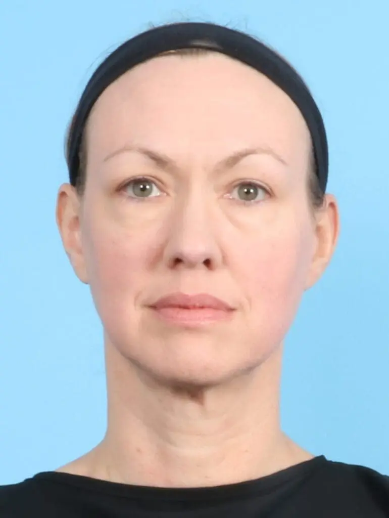 Eyelid Surgery - Case 19807 - Before