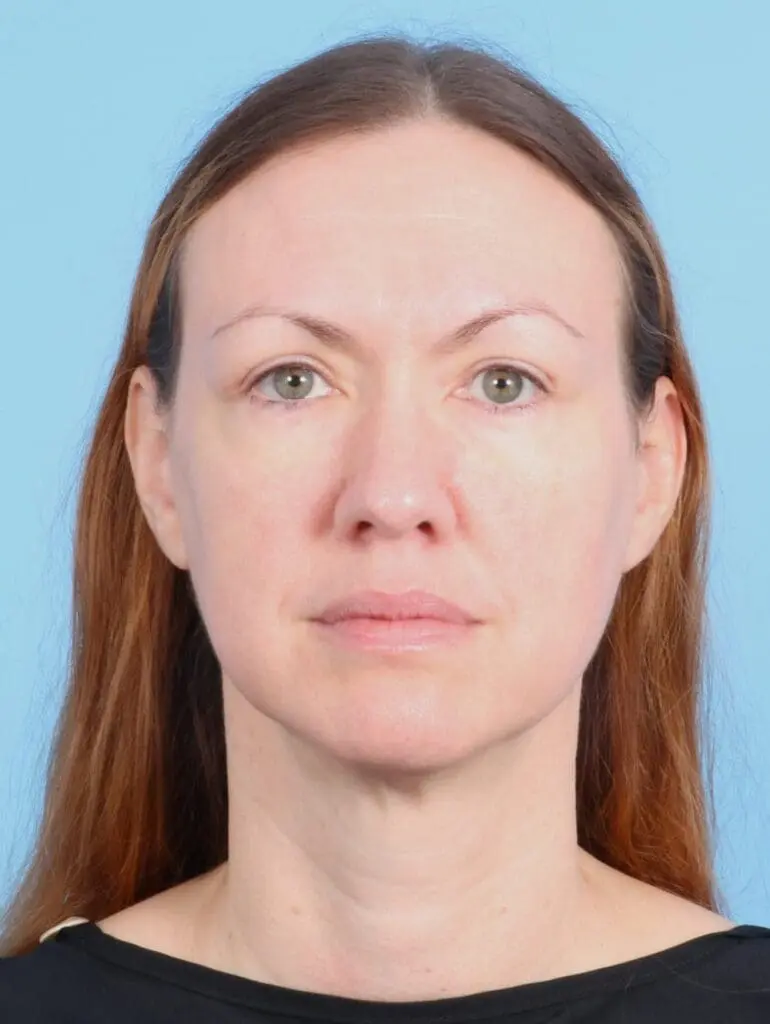 Eyelid Surgery - Case 19807 - After