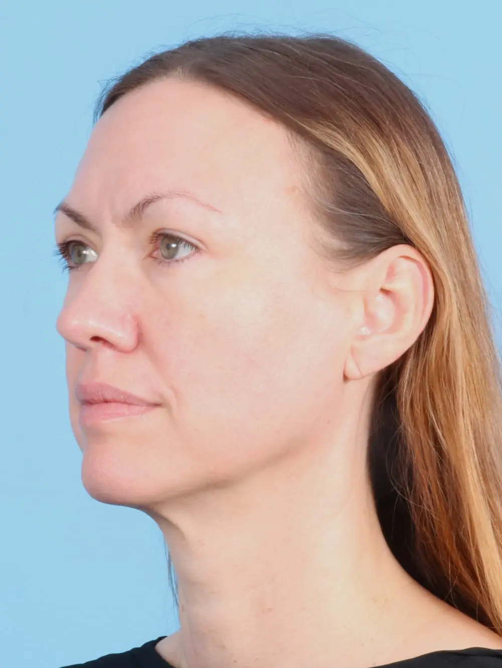 Eyelid Surgery Patient Photo - Case 19807 - after view-1