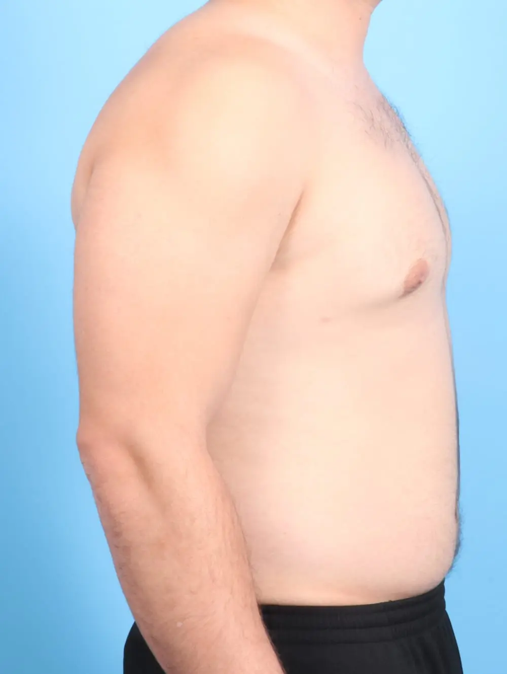 Gynecomastia Patient Photo - Case 19831 - after view-2